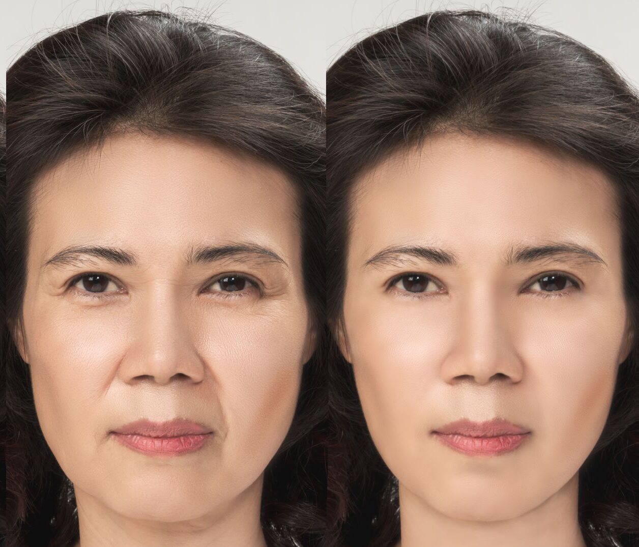 sunken-face-causes-and-treatments-in-singapore-ozhean-zoey-korean