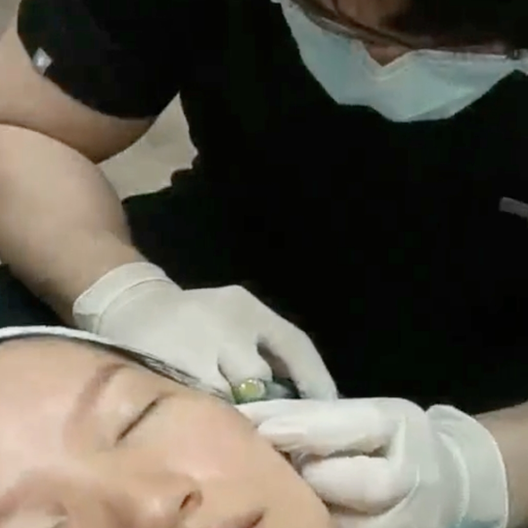 Enlarged pores image - Cytocare