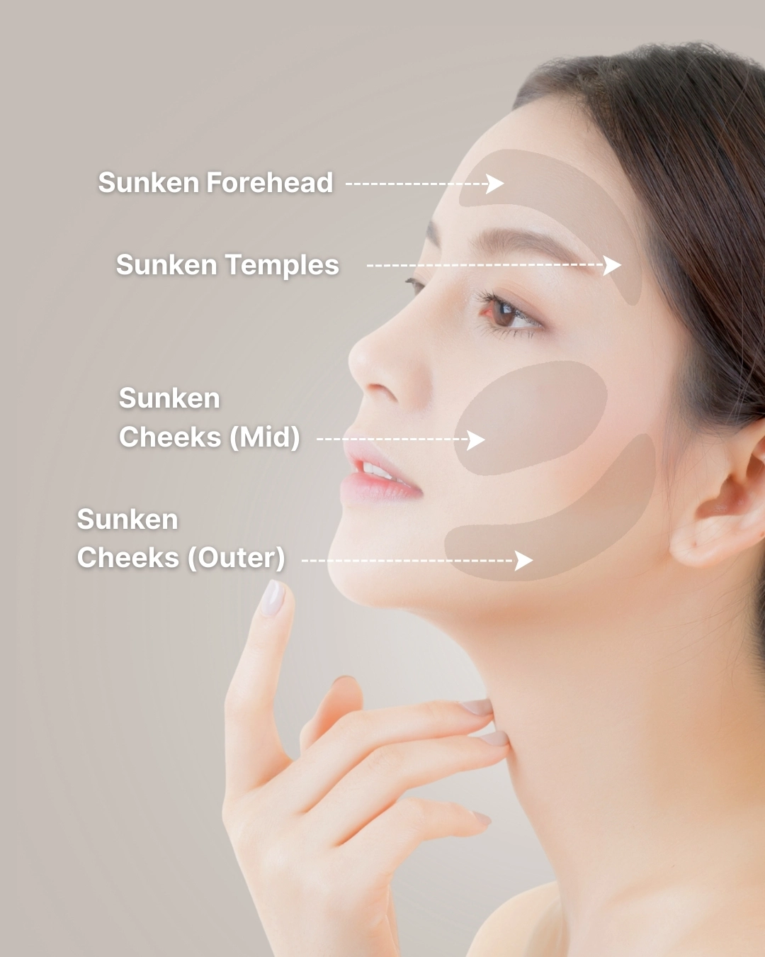 Areas Commonly Affected by Volume Loss