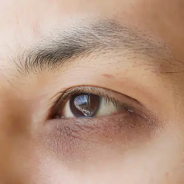 Crepey under-eye skin and dark circles