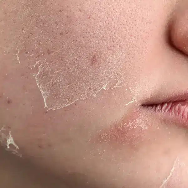 Dehydrated, dull or “tired” complexions