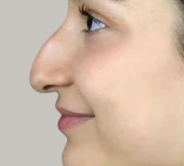 Droopy Nose Tip