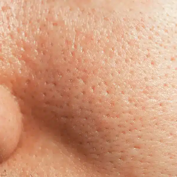 Enlarged pores and uneven texture