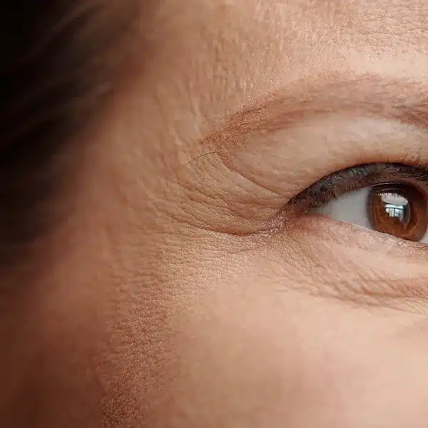 Fine lines and early wrinkles