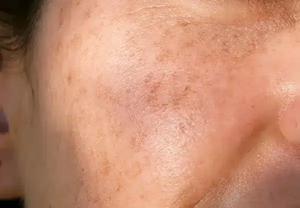 Freckles
