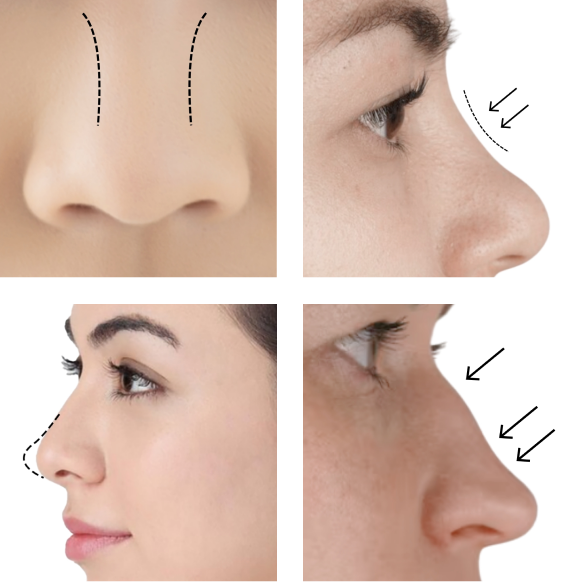 Benefits of Nose Fillers