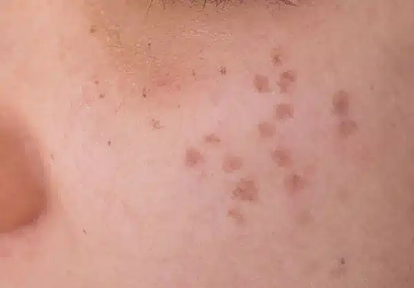 Hori’s Nevus