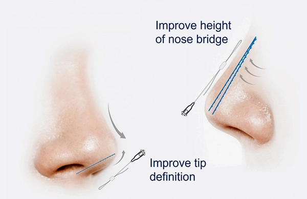 How Does Nose Thread Lift Work