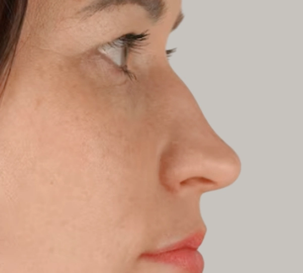 Hump or Irregularities Along the Nasal Bridge