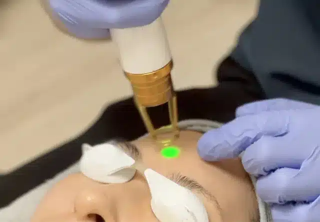 Long Pulse Laser