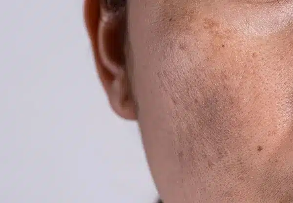 Melasma
