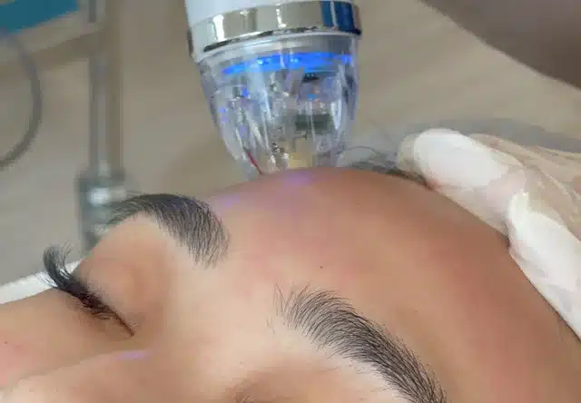 Microneedling RF