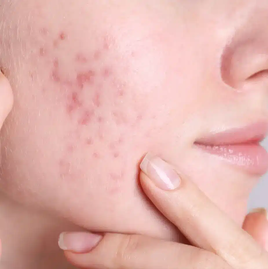 Mild-acne-scar