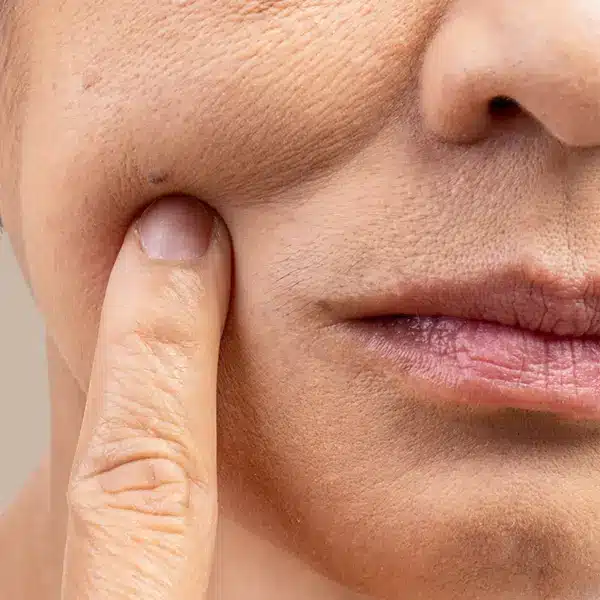 Overall loss of firmness or elasticity