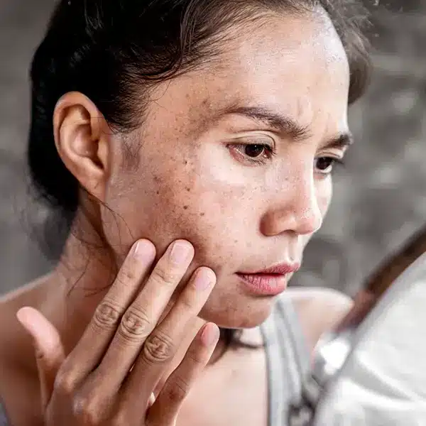 Pigmentation Treatment in Singapore