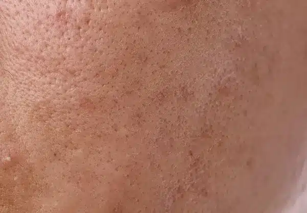 Post-Inflammatory Hyperpigmentation