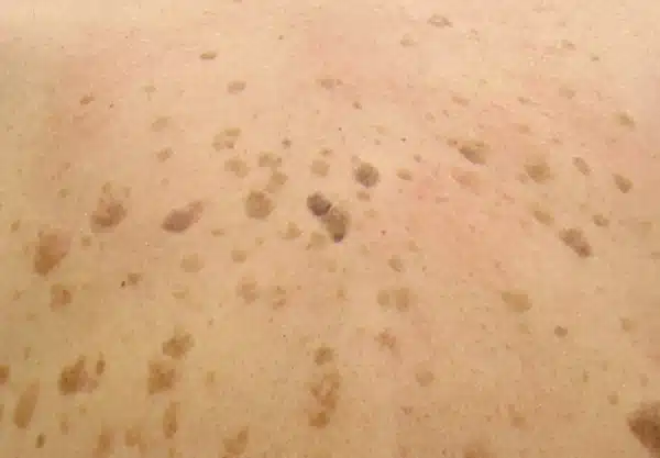 Seborrhoeic Keratosis