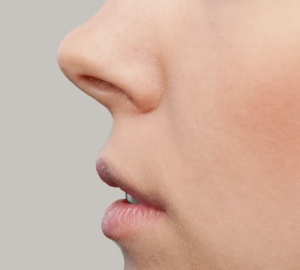 Short or Upturned Nose
