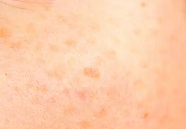 Sunspots Solar Lentigines