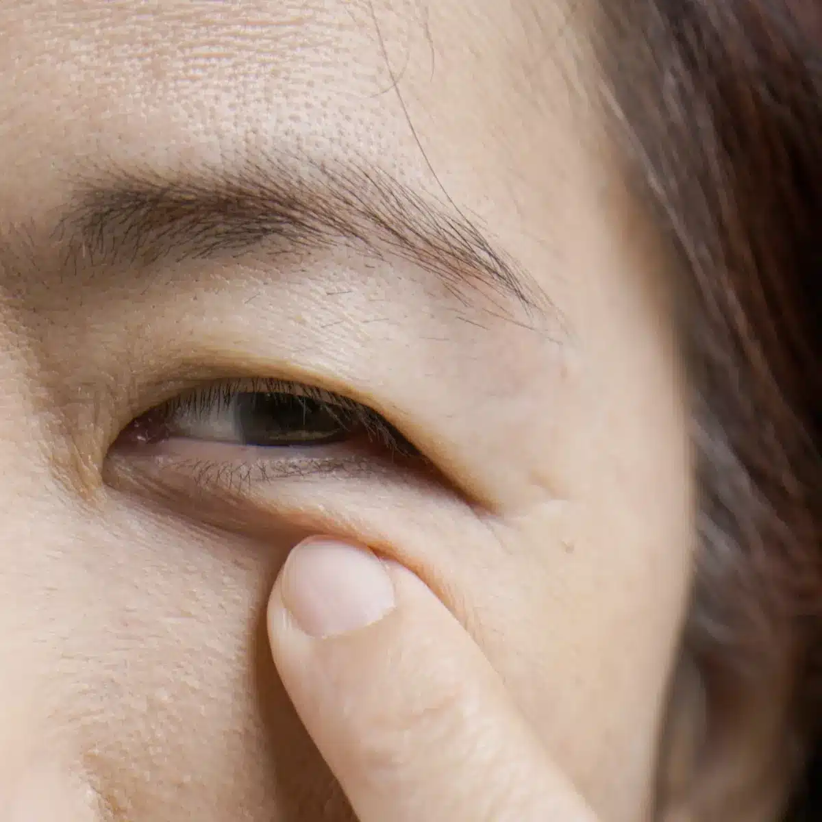 Droopy Eyelids & Brow