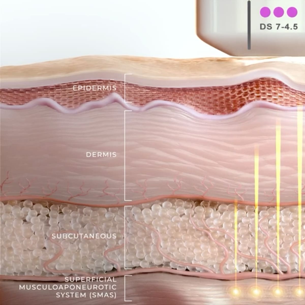 How Does Ultherapy Prime Work