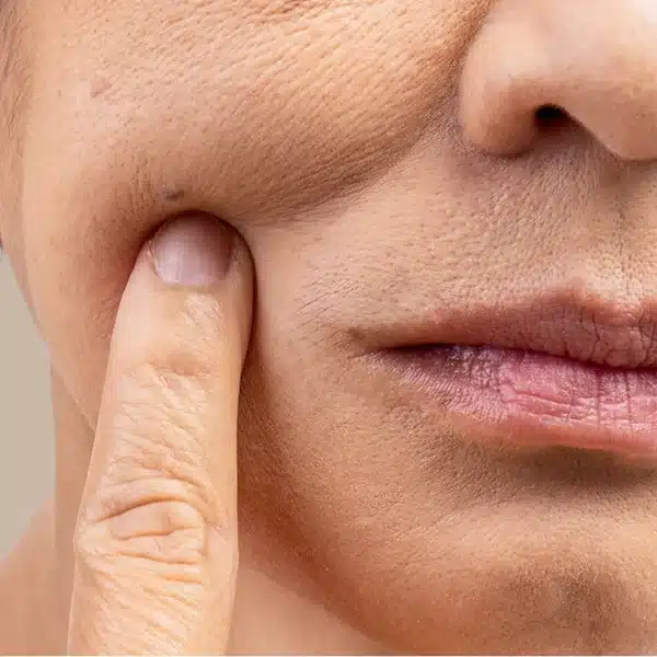 Sagging Jowls & Cheeks