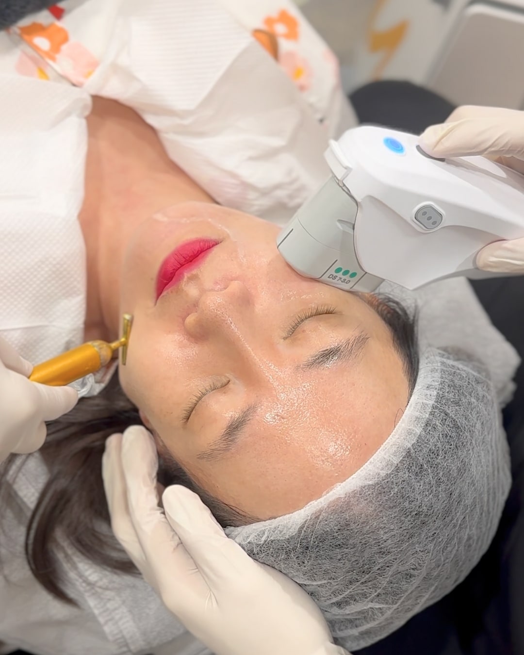 Why Ultherapy Prime at Ozhean Zoey Feels So Much More Comfortable