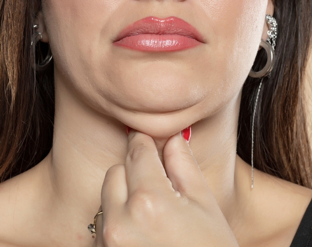Excess Submental Fat