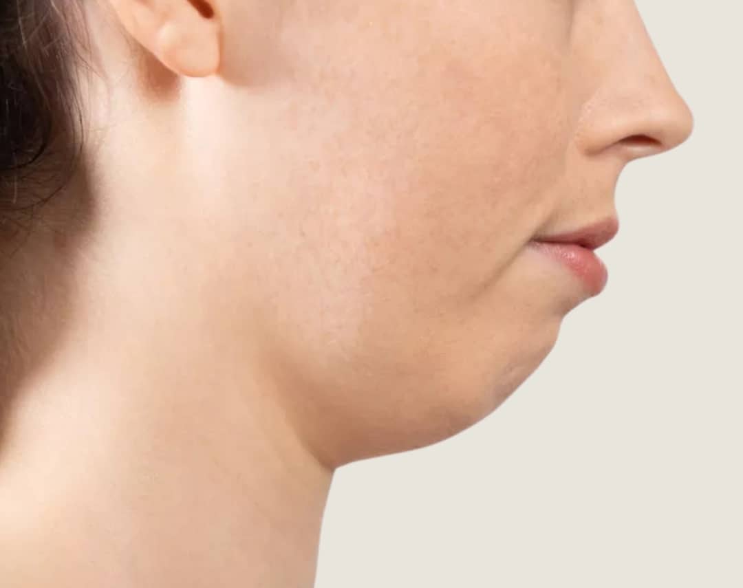 Microgenia (Small or Receding Chin)
