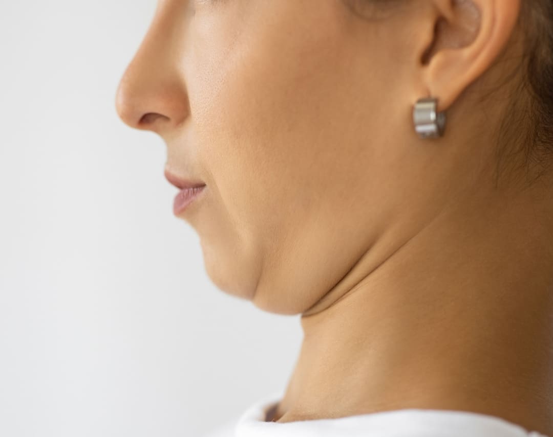 Skin Laxity (Sagging Skin)