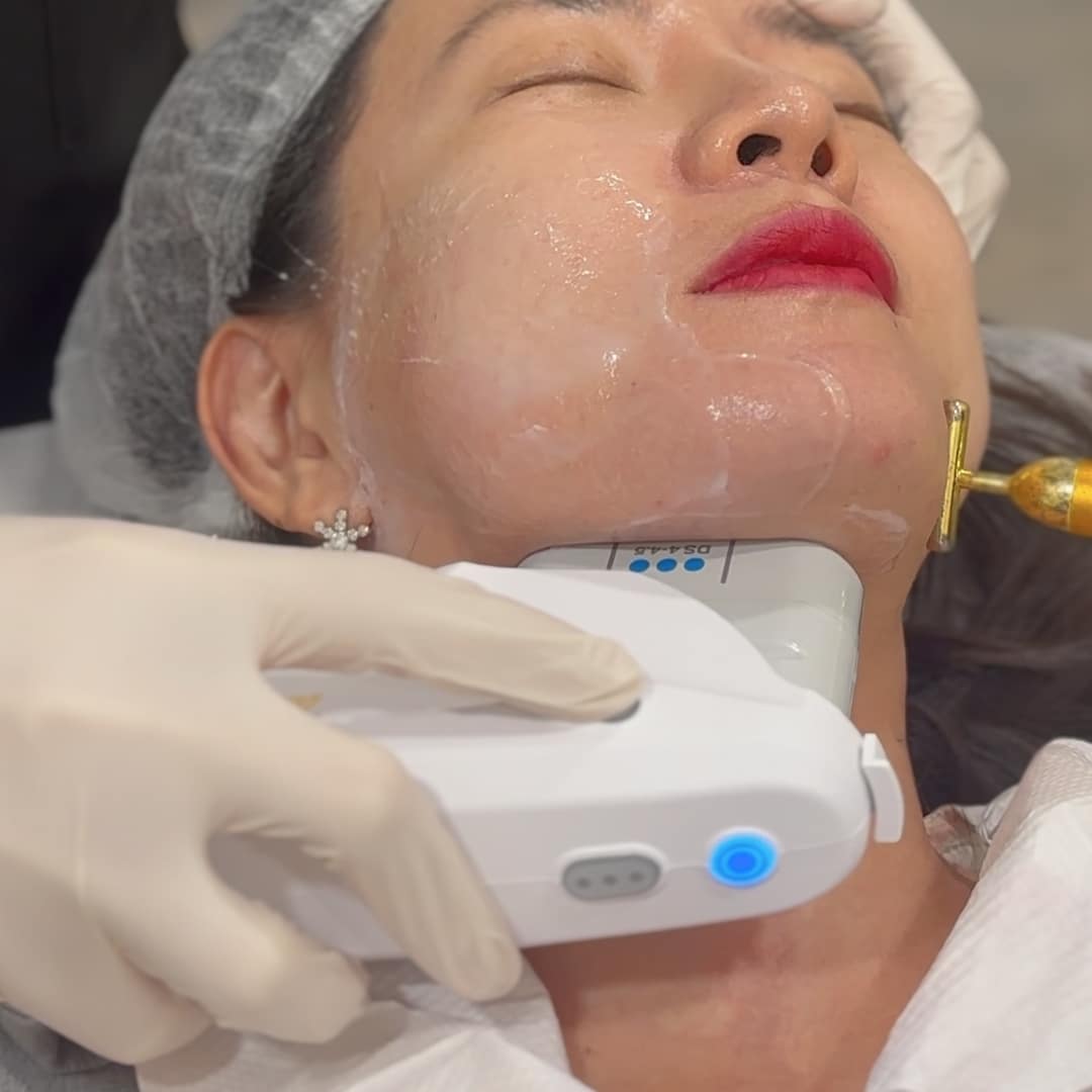 Ultherapy Prime