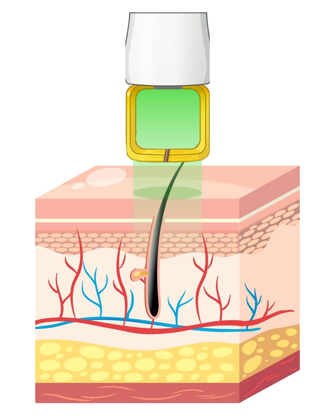 Long Pulse Laser