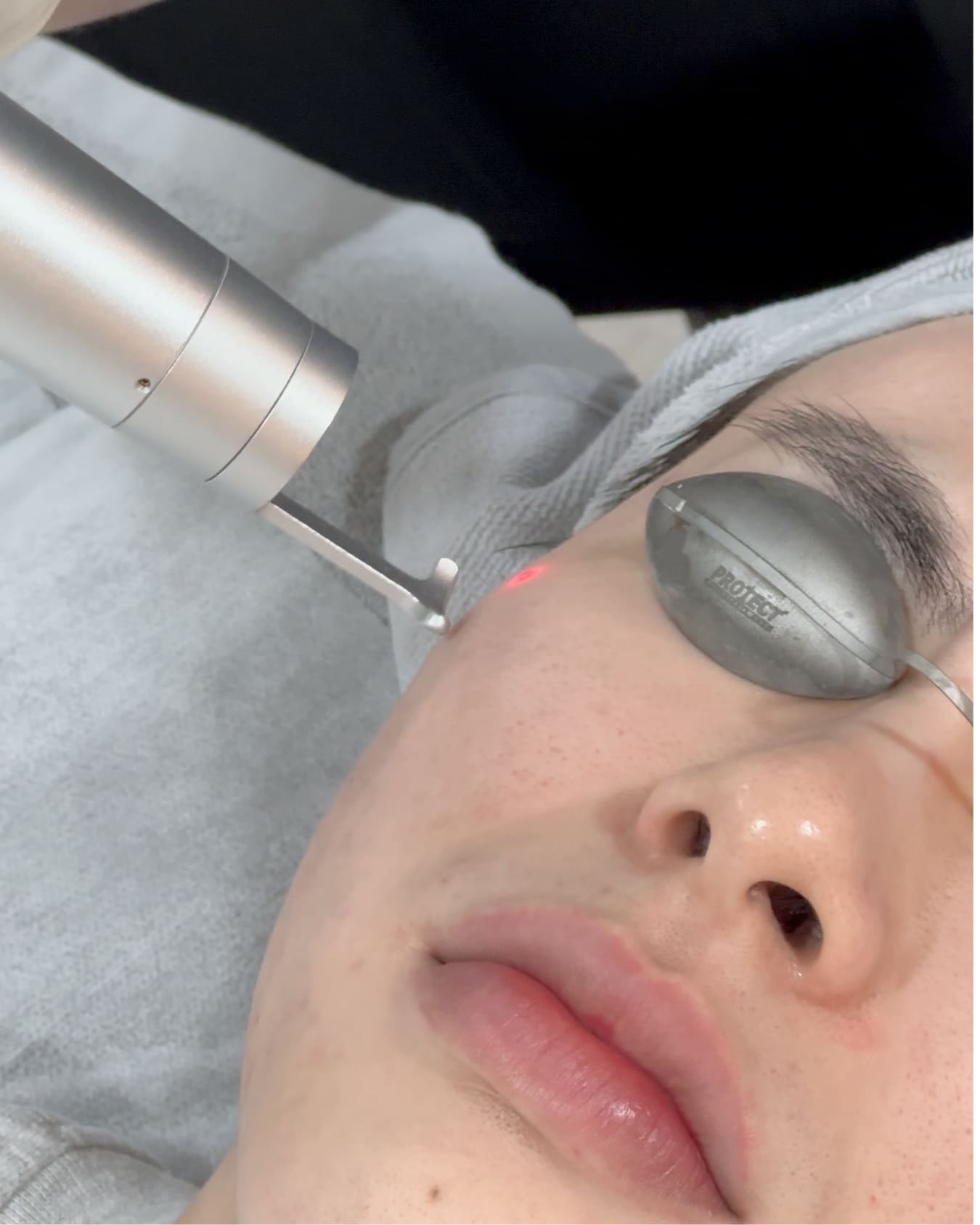 What Pico Laser Alone Cannot Fully Treat