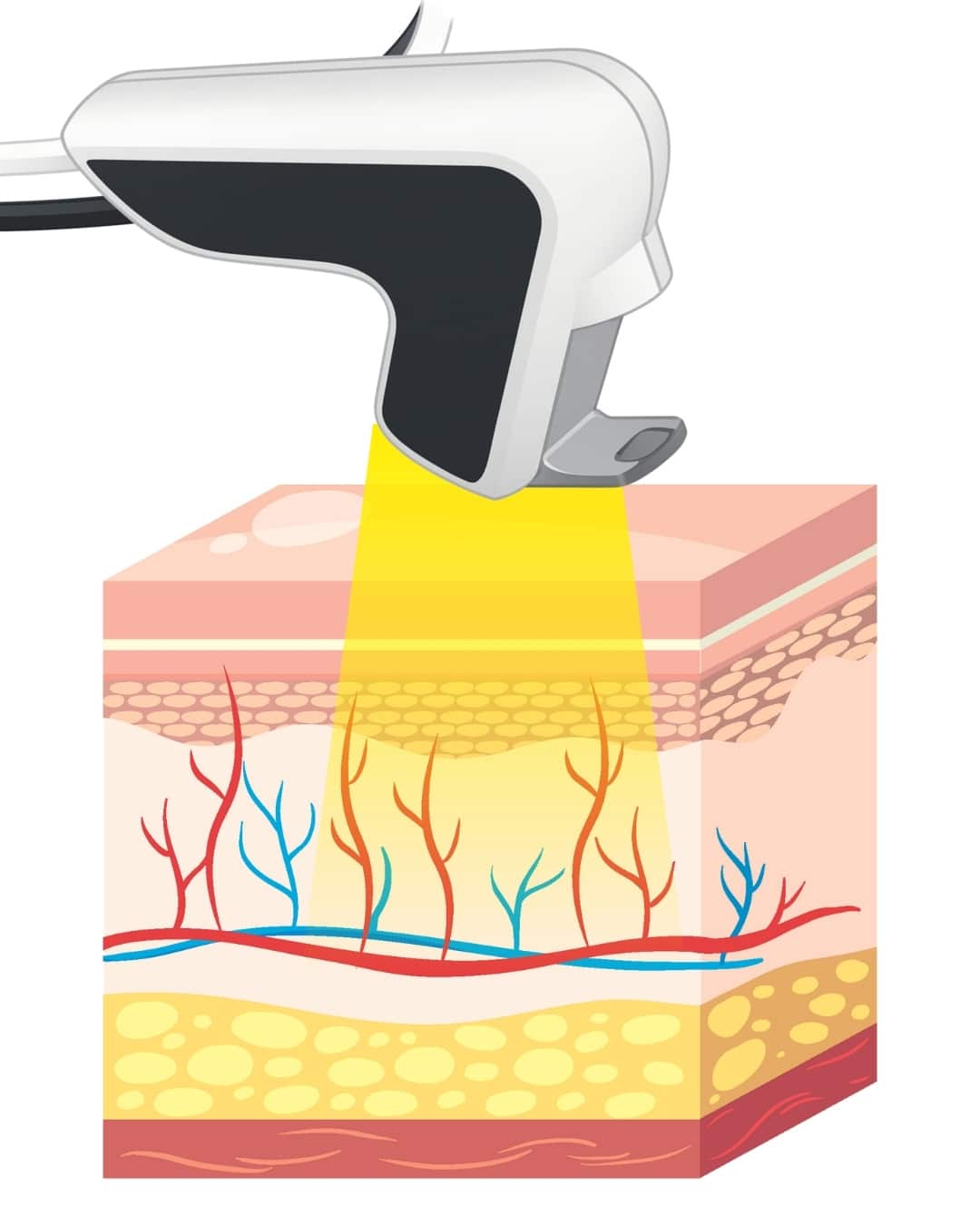 Yellow Laser