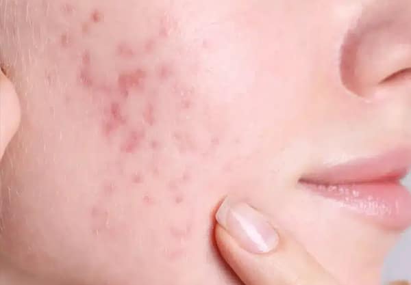 acne-marks