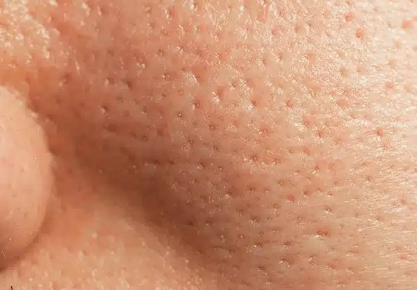enlarge-pores