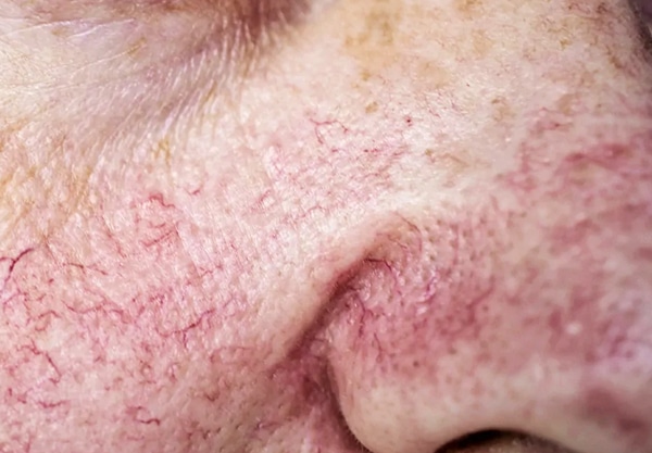 skin-redness
