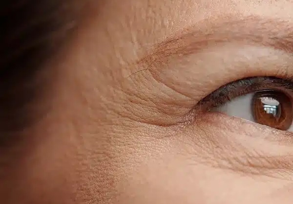 wrinkles