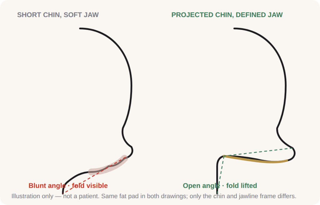 The Double Chin Treatment Nobody Expects — Define the Jawline